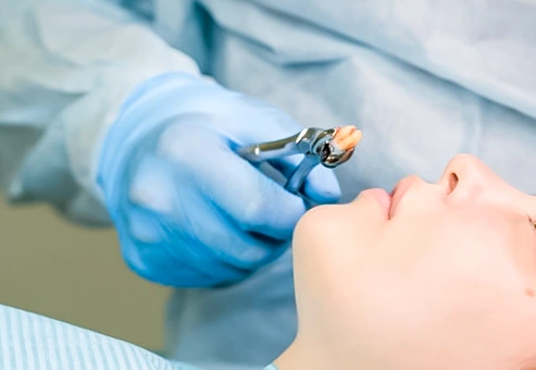 Close up wisdom tooth extracted