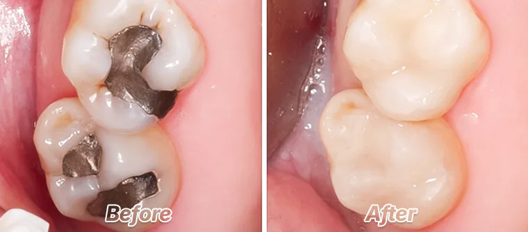 Amalgam filling removal before-after
