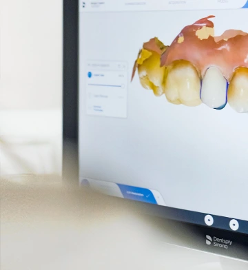 Step 2 Custom Veneers Fabrication, Dental veneers process