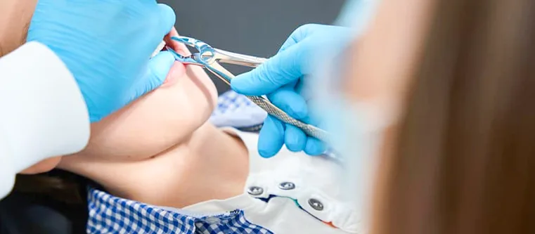 Dentist performing a simple tooth extraction