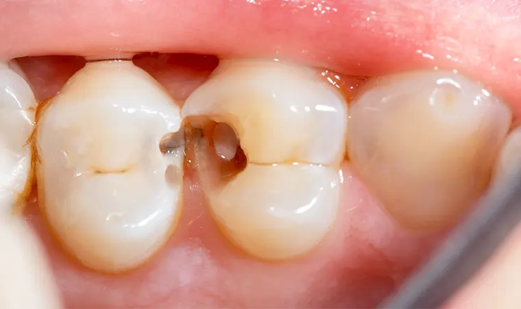 Premolars severely damaged by caries' office 02