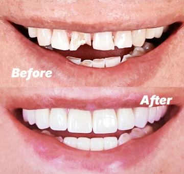 Tooth bonding before after
