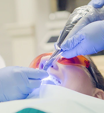 step-3-tooth-preparation-placement-dental-veneers- process