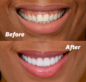 Dental filling before after