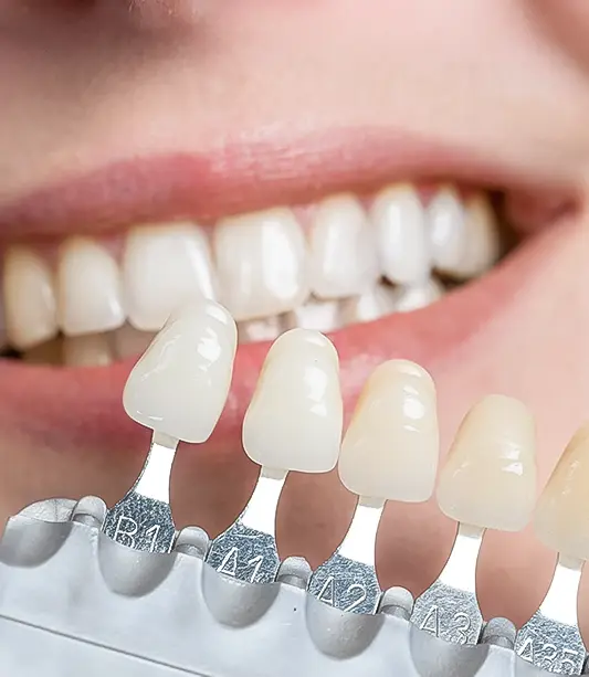 Top Quality Porcelain Veneers in San Diego