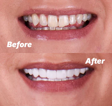 Root canal before after