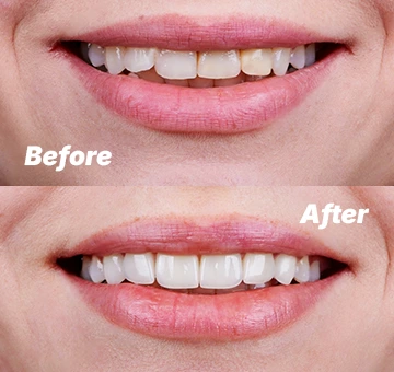Tooth bonding before after