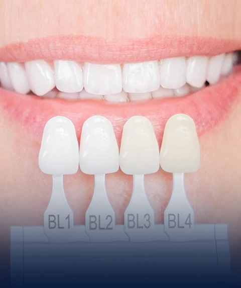 Dental veneers, shade selection