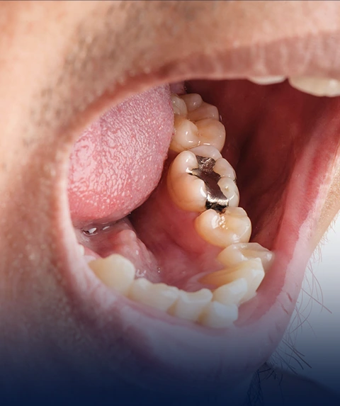 All-on-4 Fixed Hybrid Prosthesis