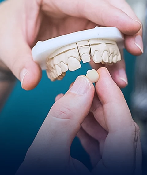 CEREC Dental Crowns
