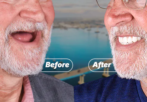 snap on dentures