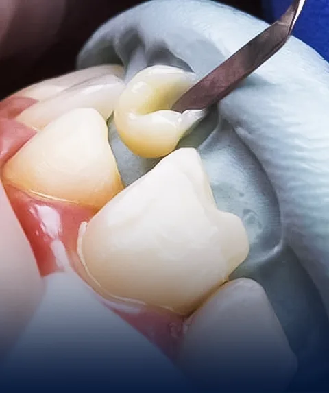 Bonding of front teeth