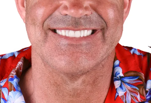 Dental Veneers at Dental Expressions, after the procedure