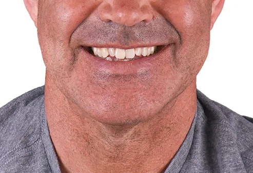 Dental Veneers at Dental Expressions, before  the procedure