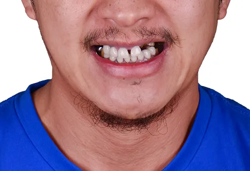 Dental Implants at Dental Expressions, before the procedure