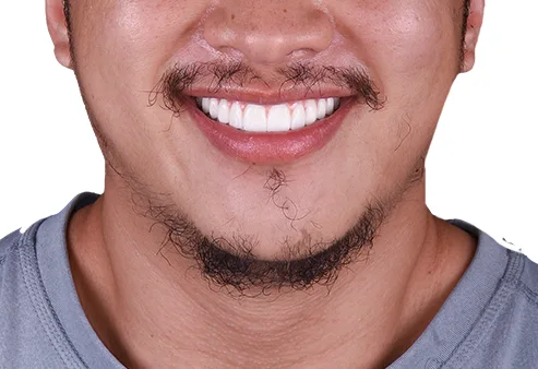Dental Implants at Dental Expressions, after the procedure