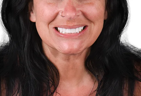 Smile Makeover at Dental Expressions, after