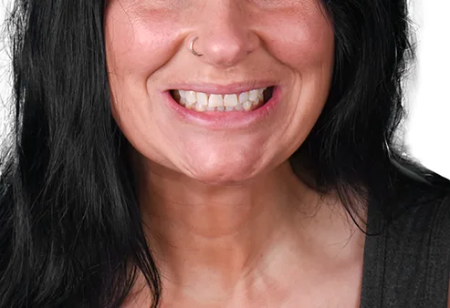 Smile Makeover at Dental Expressions, before the procedure