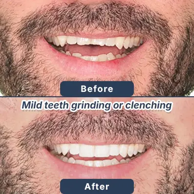 Dental crowns before after