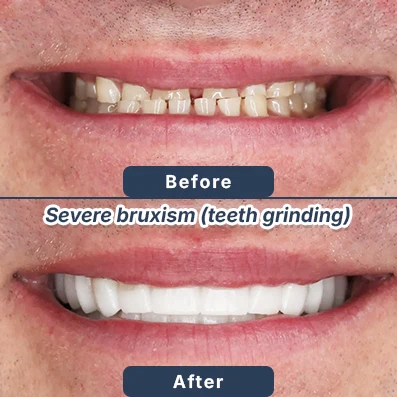Root canal before after