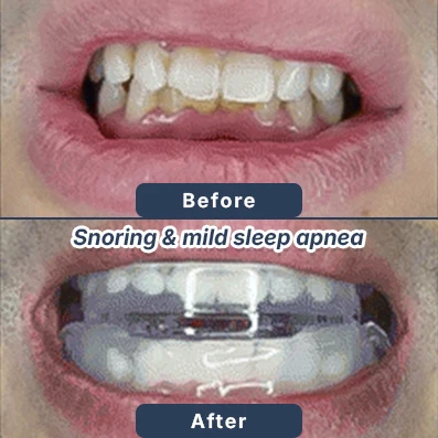 Dental filling before after
